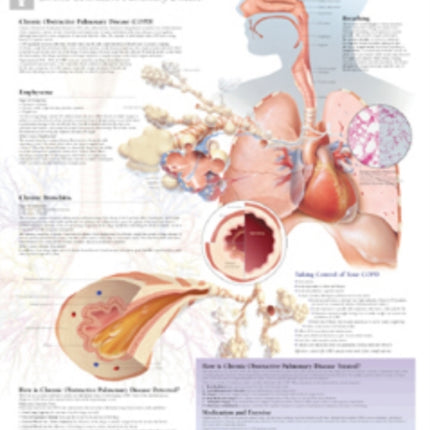 COPD (Chronic Obstructive Pulmonary Disease) Laminated Poster