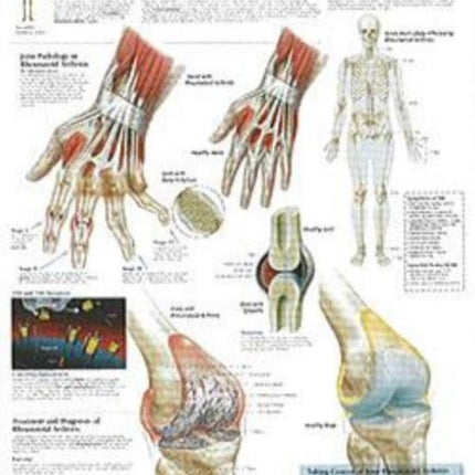 Rheumatoid Arthritis Paper Poster