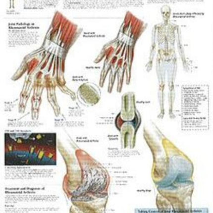 Rheumatoid Arthritis Laminated Poster