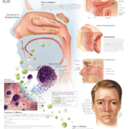 Understanding Rhinitis Paper Poster