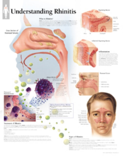 Understanding Rhinitis Laminated Poster