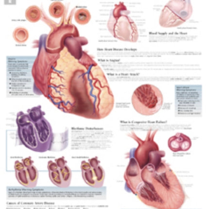 Understanding Heart Disease Laminated Poster