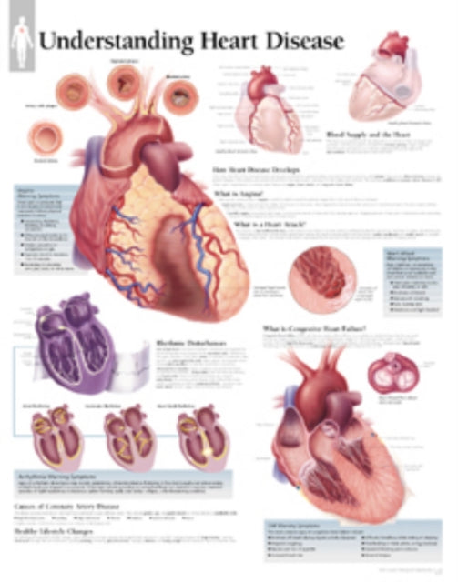 Understanding Heart Disease Laminated Poster