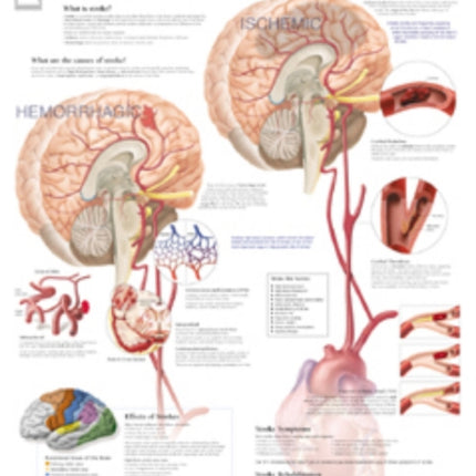 Understanding Stroke Paper Poster