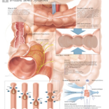 Understanding IBS Laminated Poster