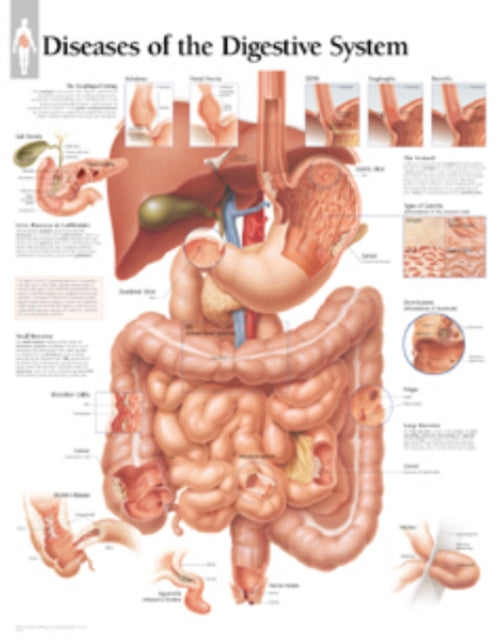 Diseases of the Digestive System Laminated Poster