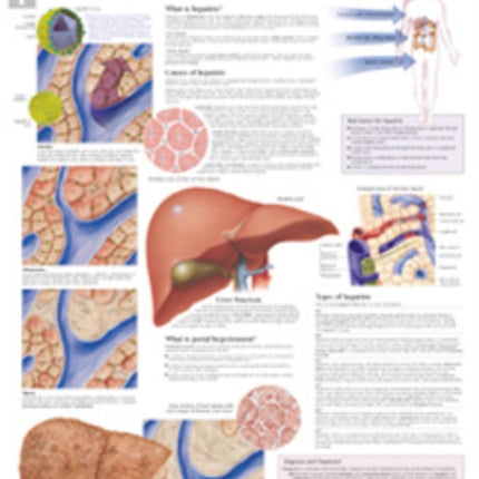 Understanding Hepatitis Laminated Poster