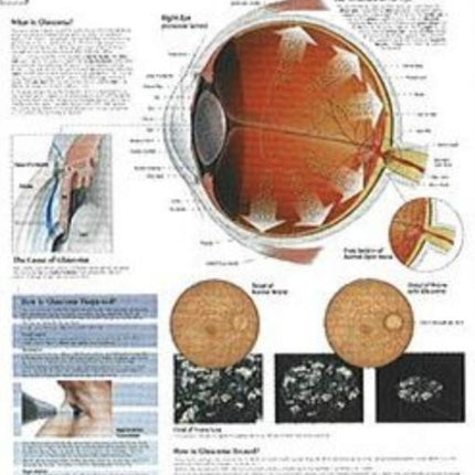 Understanding Glaucoma Paper Poster