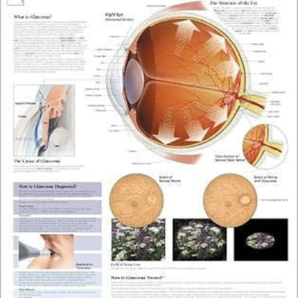 Understanding Glaucoma Laminated Poster