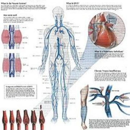 Understanding DVT Laminated Poster