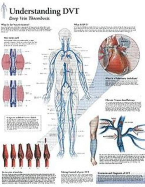 Understanding DVT Laminated Poster