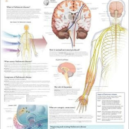 Understanding Parkinson's Laminated Poster