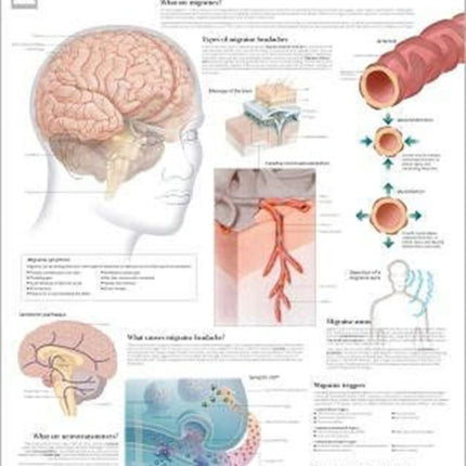 Understanding Migraines Laminated Poster