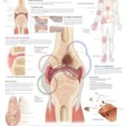 Understanding Arthritis Laminated Poster