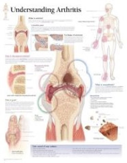 Understanding Arthritis Laminated Poster