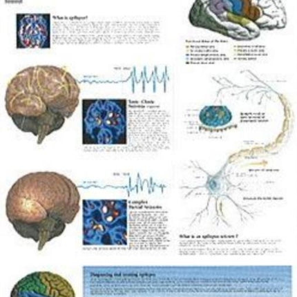 Understanding Epilepsy Laminated Poster