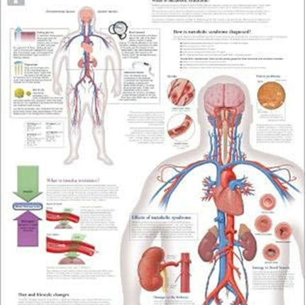 Understanding Metabolic Syndrome Laminated Poster