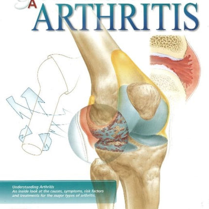 Understanding Arthritis Flip Chart