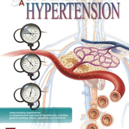 Understanding Hypertension Flip Chart