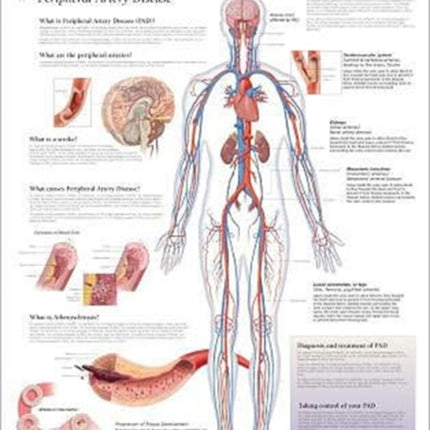 Understanding PAD Laminated Poster