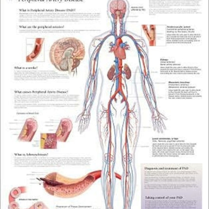 Understanding PAD Paper Poster