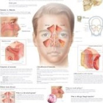 Understanding Sinusitis Laminated Poster