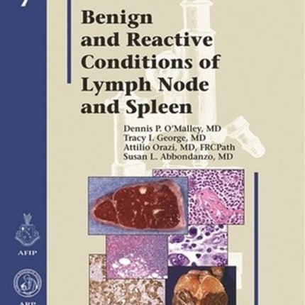 Benign and Reactive Conditions of Lymph Node and