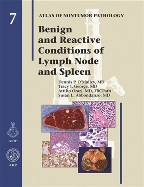 Benign and Reactive Conditions of Lymph Node and