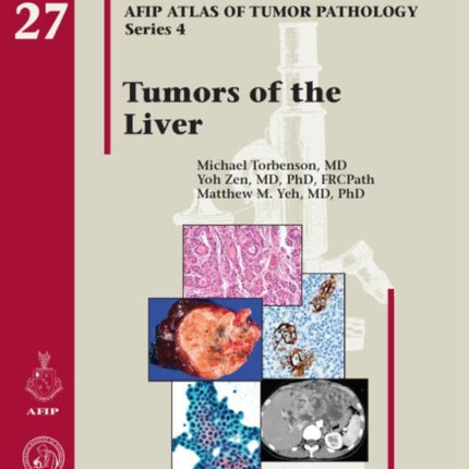 Tumors of the Liver
