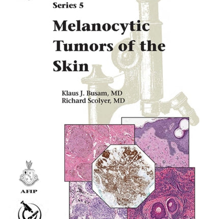 Melanocytic Tumors of Skin