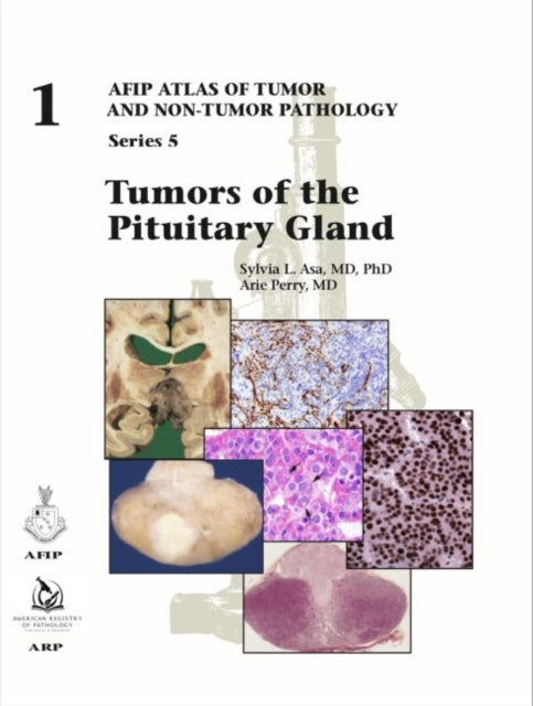 Tumors of the Pituitary Gland