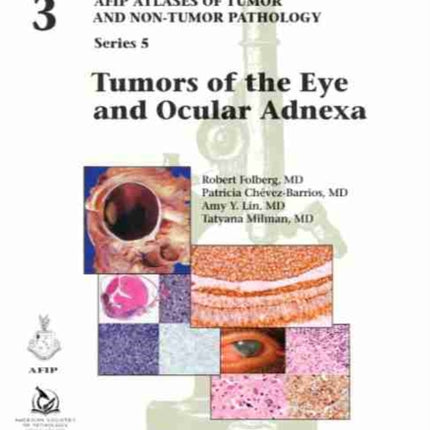 Tumors of the Eye and Ocular Adnexa