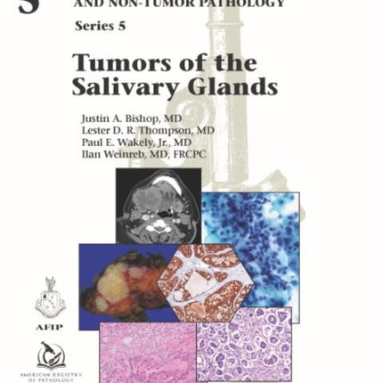 Tumors of the Salivary Glands