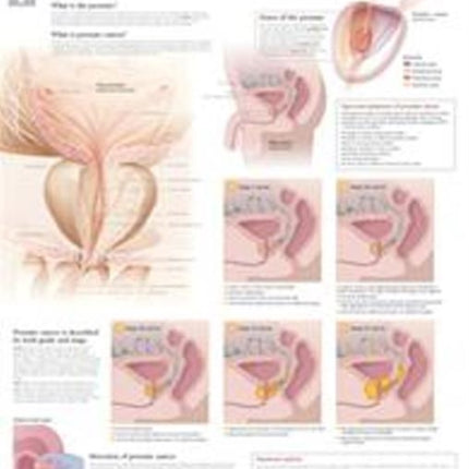 Understanding Prostate Cancer Paper Poster