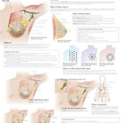 Understanding Breast Cancer Paper Poster