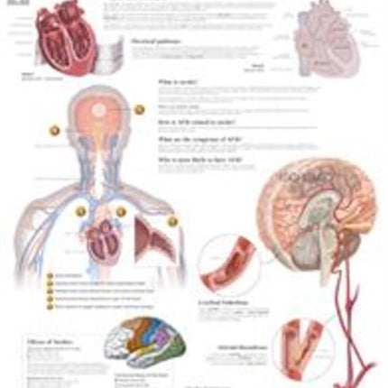 Atrial Fib & Ischemic Strokes Laminated Poster