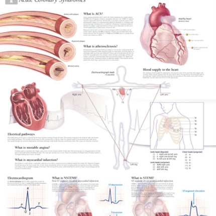 Understanding ACS (Acute Coronary Syndrome) Laminated Poster