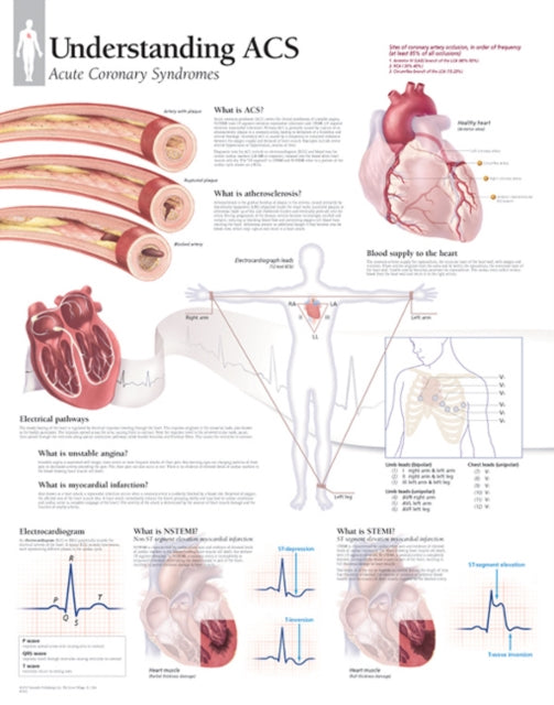 Understanding ACS (Acute Coronary Syndrome) Laminated Poster