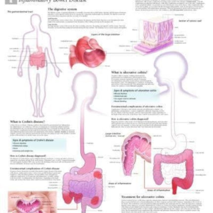 Understanding IBD