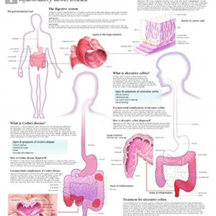 Understanding IBD