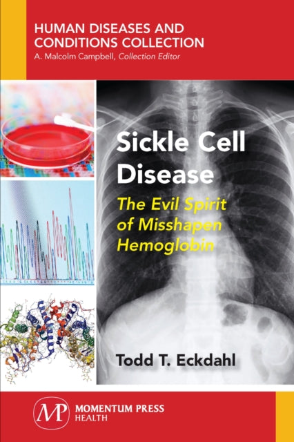 Sickle Cell Disease: The Evil Spirit of Misshapen Hemoglobin