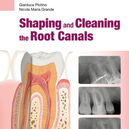 Shaping and Cleaning the Root Canal System