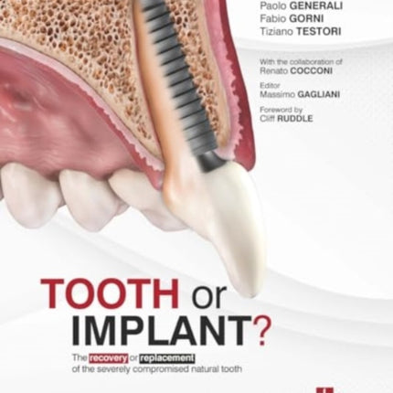 Tooth or Implant