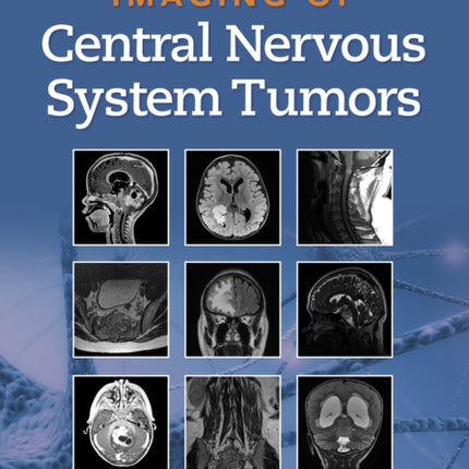 Imaging of Central Nervous System Tumors