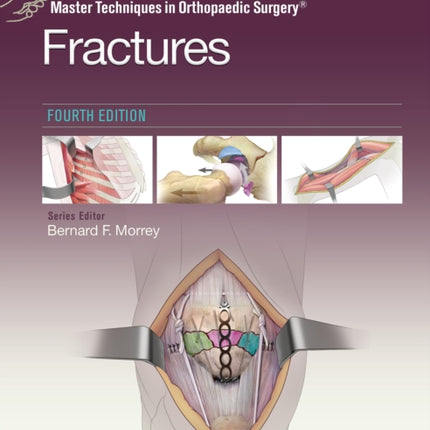 Master Techniques in Orthopaedic Surgery: Fractures