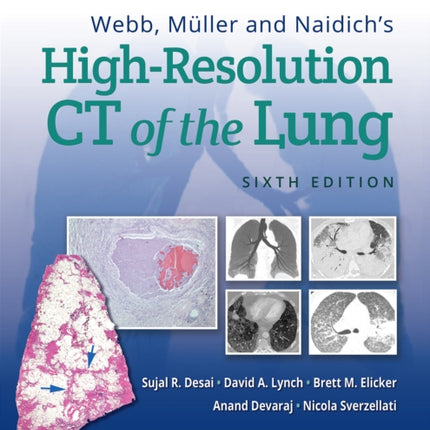 Webb, Müller and Naidich's High-Resolution CT of the Lung