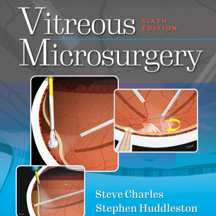 Vitreous Microsurgery