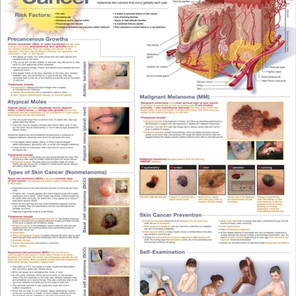Understanding Skin Cancer Anatomical Chart