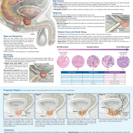 Understanding Prostate Cancer Anatomical Chart