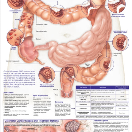 Understanding Colorectal  Cancer Anatomical Chart
